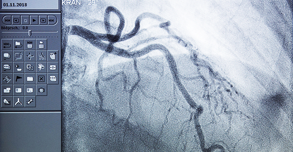 X-ray image of the coronary vessels